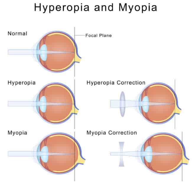 hyperopia and myopia illustration
