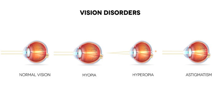 illustration of eyes in vision disorders