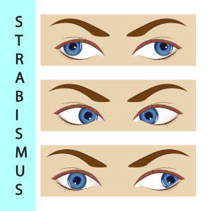 illustrations of strabismus condition