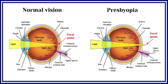 diagram of eyeball with normal vision vs. presbyopia